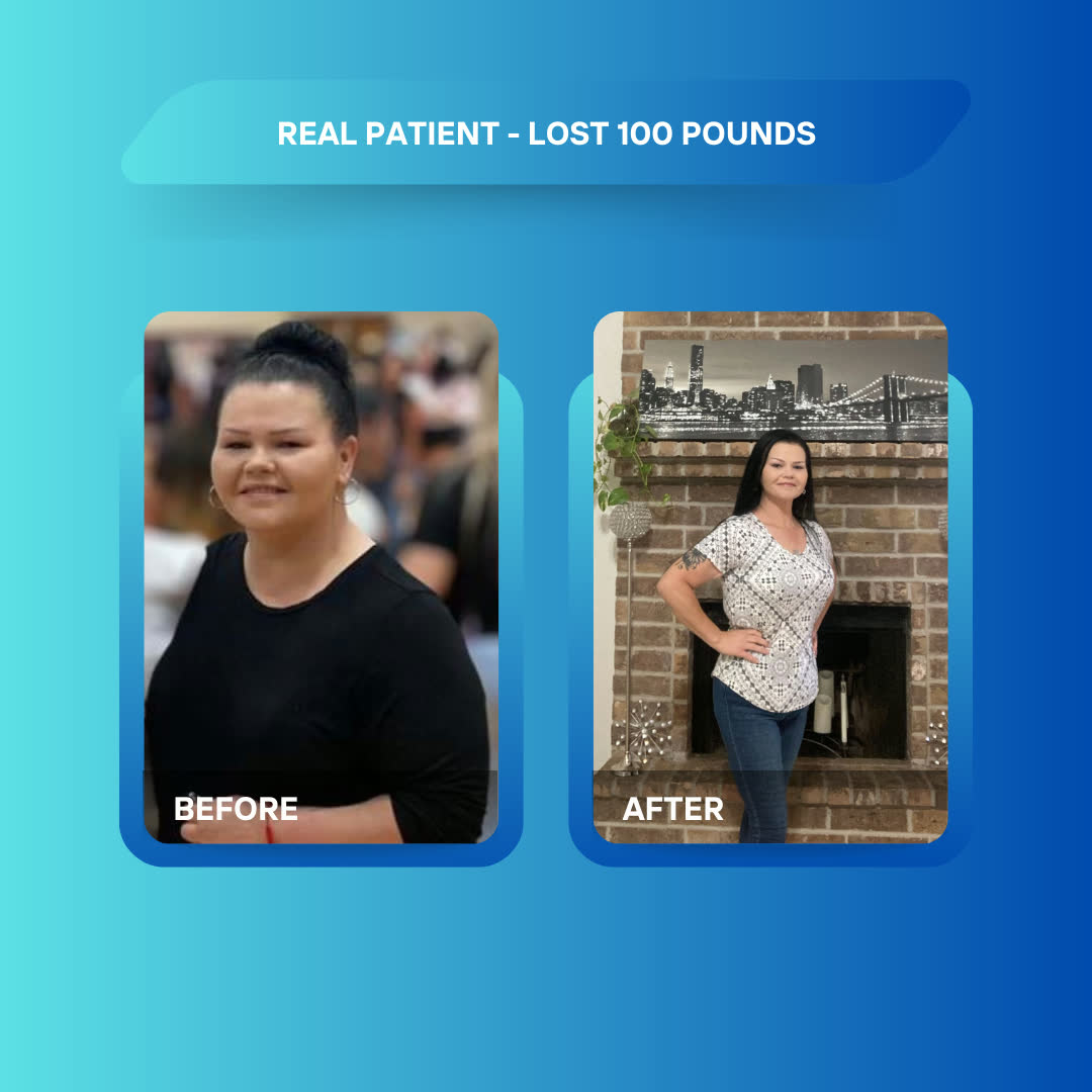 Real patient before and after losing 100 pounds